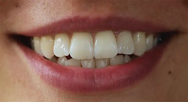 SmileBite Testperson 2 Gelb SmileBite Testperson 2 Gelb