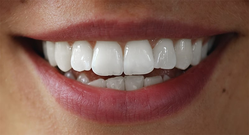 SmileBite Testperson 2 Weiß 2 SmileBite Testperson 2 Weiß 2