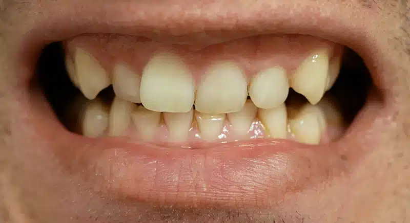 SmileBite Testperson 4 Gelb SmileBite Testperson 4 Gelb