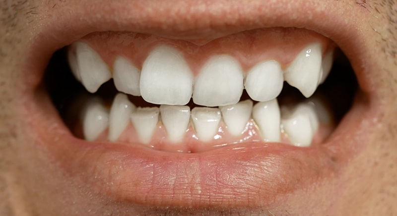 SmileBite Testperson 4 Weiß 2 SmileBite Testperson 4 Weiß 2