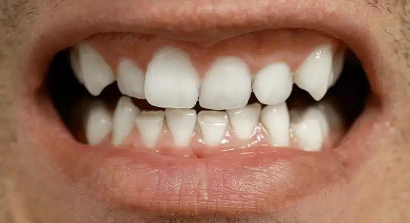 SmileBite Testperson 4 Weiß 2 SmileBite Testperson 4 Weiß 2