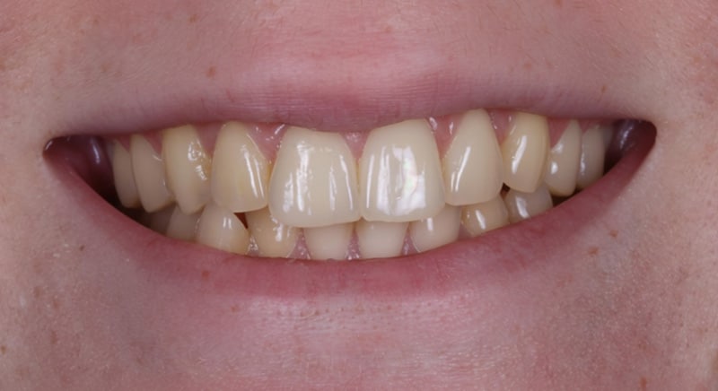 Testperson 3 SmilePro Zahnaufheller Set VORHER Testperson 3 SmilePro Zahnaufheller Set VORHER