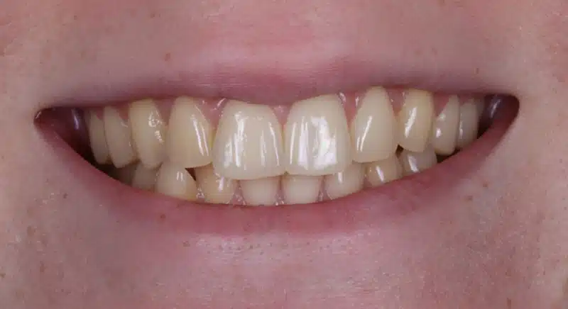 Testperson 3 SmilePro Zahnaufheller Set VORHER Testperson 3 SmilePro Zahnaufheller Set VORHER