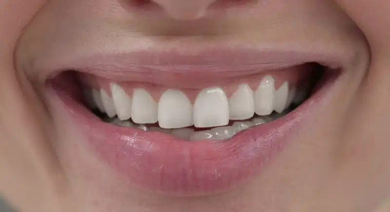 Testperson 4 SmileBite Zahnaufheller Set NACHHER Testperson 4 SmileBite Zahnaufheller Set NACHHER