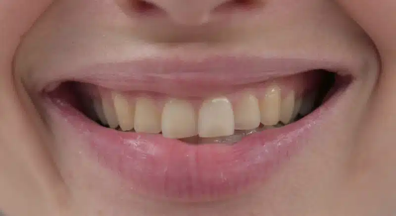 Testperson 4 SmileBite Zahnaufheller Set VORHER Testperson 4 SmileBite Zahnaufheller Set VORHER